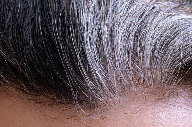 Pigment v laseh se neha tvoriti zaradi različnih vzrokov
