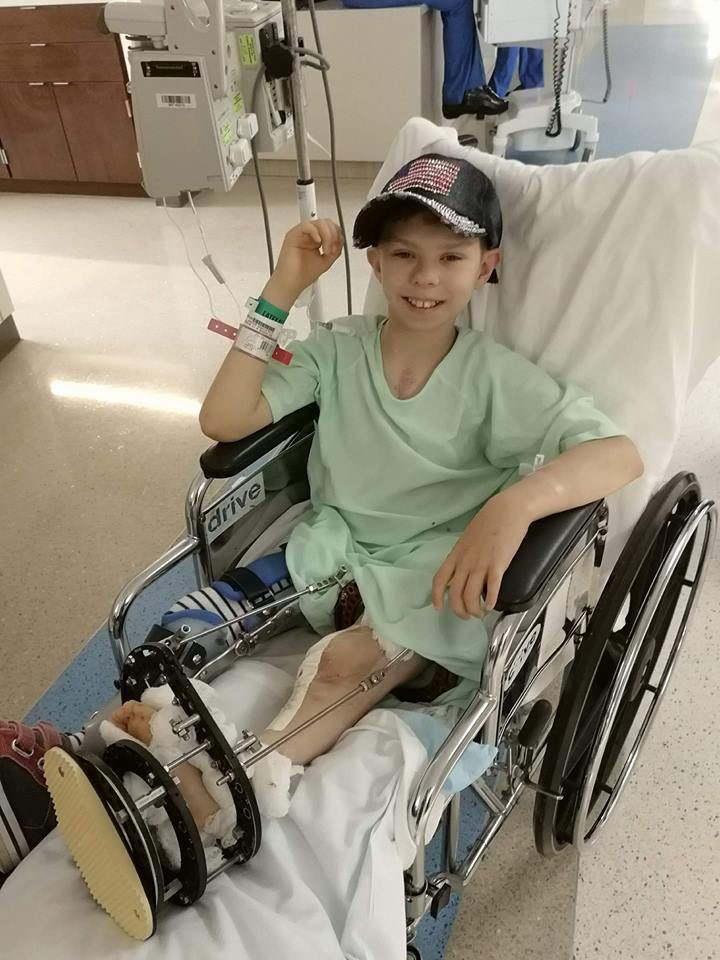 Fotografija: Prva operacija je trajala več kot šest ur, v tem času so mu na levi nogi naravnali stopalo in operirali tudi koleno. FOTO: Facebook