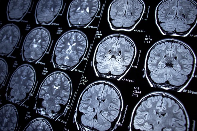 Osebe z epilepsijo imajo nenormalno spremenjeno možgansko električno aktivnost. FOTO: Nur Ceren Demir/Getty Images
