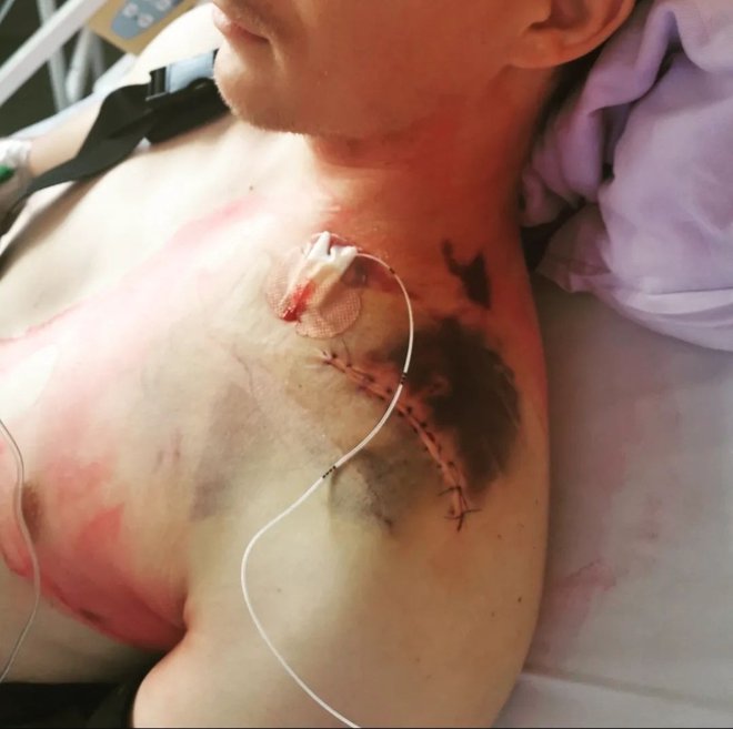 Jurij Tepeš, ki je svojo strast našel v gorskem kolesarstvu, je pred meseci staknil grde poškodbe. FOTO: INSTAGRAM
