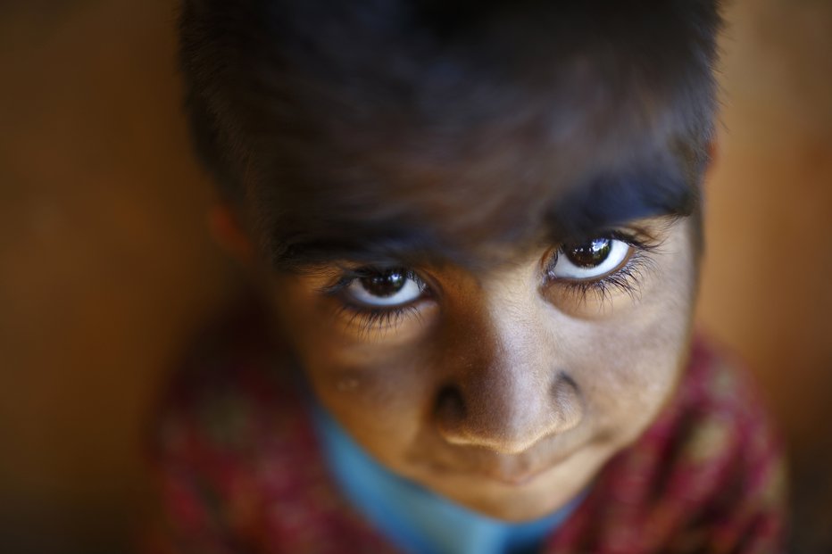 Fotografija: Otrok s hipertrihozo. FOTO: Navesh Citrakar