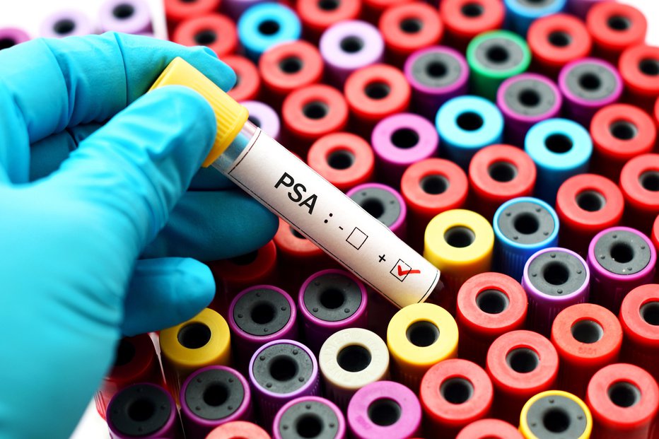 Fotografija: Pri krvni preiskavi določijo vrednost prostatičnega specifičnega antigena. FOTO: Guliver/Getty Images