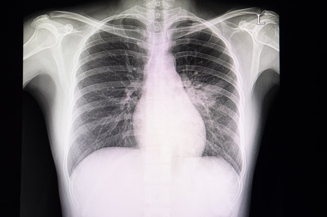 Za 20 odstotkov ljudi je pnevmokokna pljučnica usodna. FOTO: Guliver/Getty Images