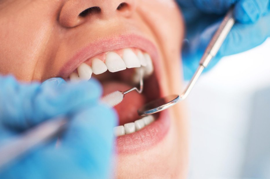 Fotografija: K zobozdravniku je treba, preden zob začne boleti.  FOTO: Thinkstock