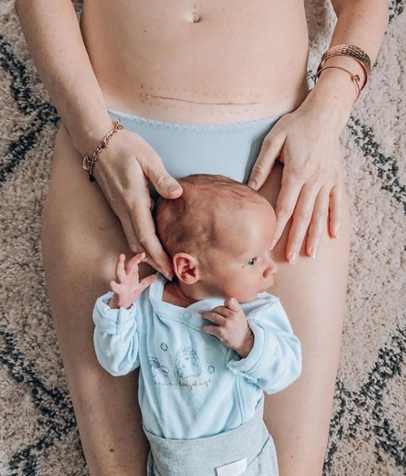 Anja je delila fotografijo brazgotine in porodno izkušnjo. FOTO: Instagram