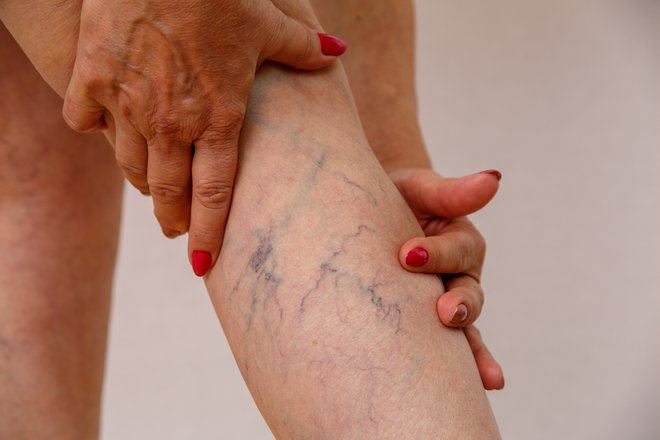Bolezen se lahko pokaže tudi z razširjenimi venami ali krčnimi žilami. FOTO: Guliver/Getty Images