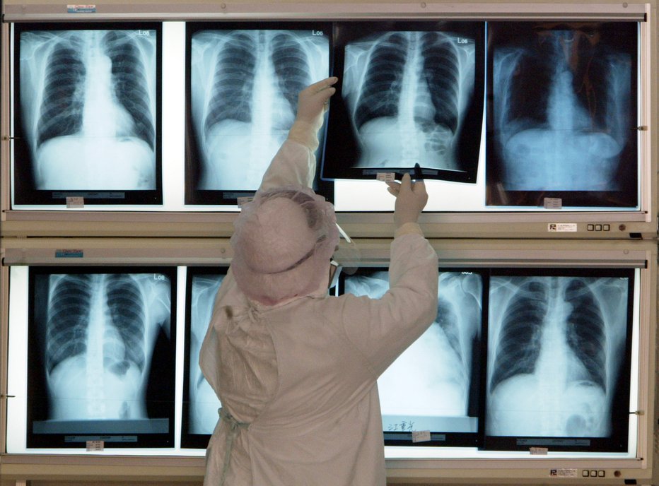 Fotografija: Virus pri številnih pacinetih povzroči težave pri dihanju, kar lahko v najhujših primerih vodi do smrti. FOTO: Richard Chung, Reuters