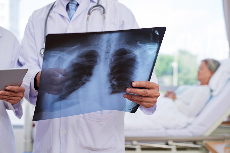 Fotografija: Pnevmokoki povzročajo različne bolezni, pri starejših najpogosteje pljučnico. FOTO: Dragonimages/Getty Images