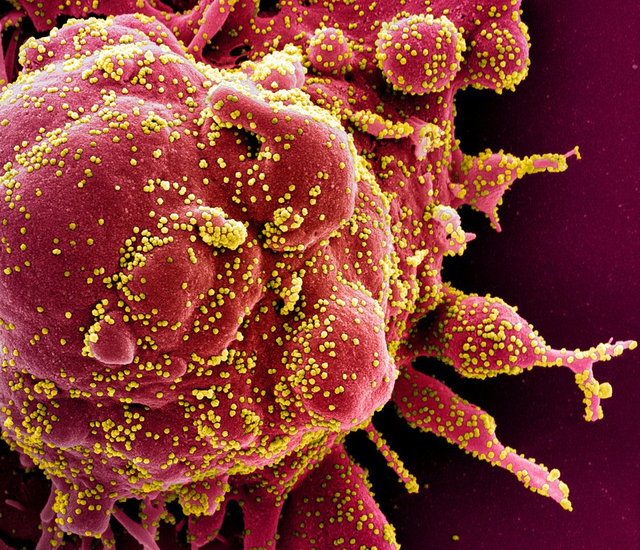 Fotografija: Okužena celica s koronavirusom. FOTO: Niaid Via Reuters