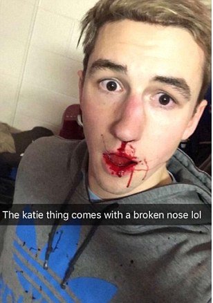 Ben je fotografijo zlomljenega nosu objavil na družabnem omrežju. FOTO: Snapchat