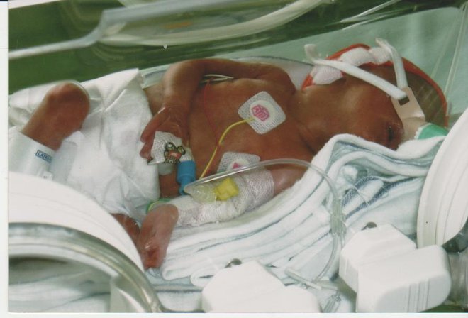 Po rojstvu je morala Nika v inkubator. FOTO: Družinski Arhiv
