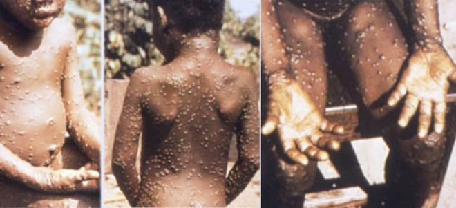 Bolezen prihaja iz Afrike, najpogosteje zbolevajo otroci. FOTO: Wikipedia