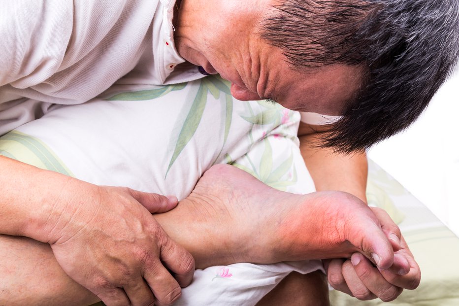 Fotografija: Akutni napad protina navadno poteka kot vnetje osnovnega sklepa palca na nogi.