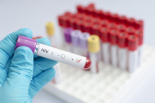 Z antiretrovirusno terapijo lahko povsem obvladamo virus hiv.