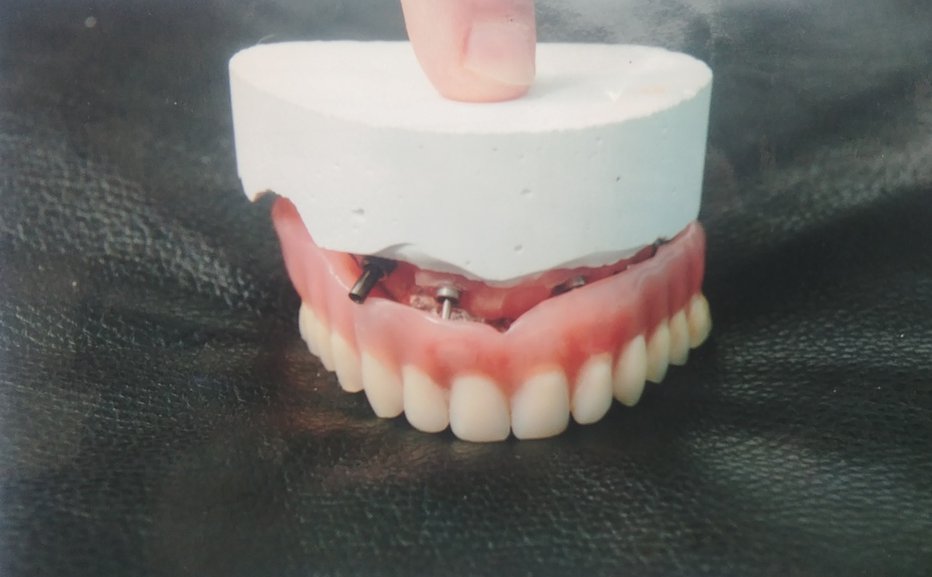 Fotografija: Takšno je bilo stanje zobovja po posegu. FOTO: Osebni arhiv