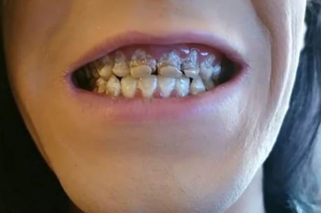 Fotografija: Energijske pijače so mu popolnoma uničile zobe. FOTO: Youtube, posnetek zaslona