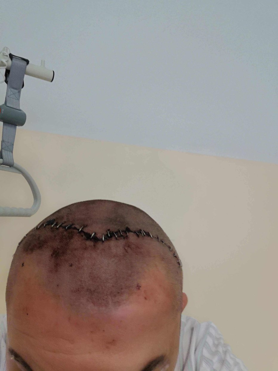 Fotografija: Markova glava po napadu in operaciji FOTO: Osebni arhiv