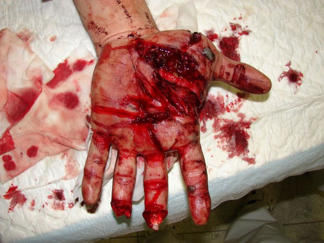 Doslej najhujši primer samopoškodovanja, ki je bil odkrit kot goljufija, je primer moškega, ki si je odrezal prst. FOTO: Arhiv Slovenske Novice