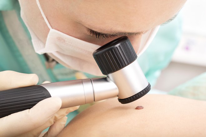 Z dermatoskopijo dermatolog prepoznava kožne spremembe. FOTO: Guliver/Getty Images