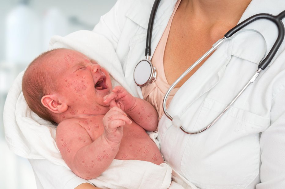 Fotografija: Največje tveganje za zaplete in smrt imajo dojenčki in imunsko oslabljene osebe.