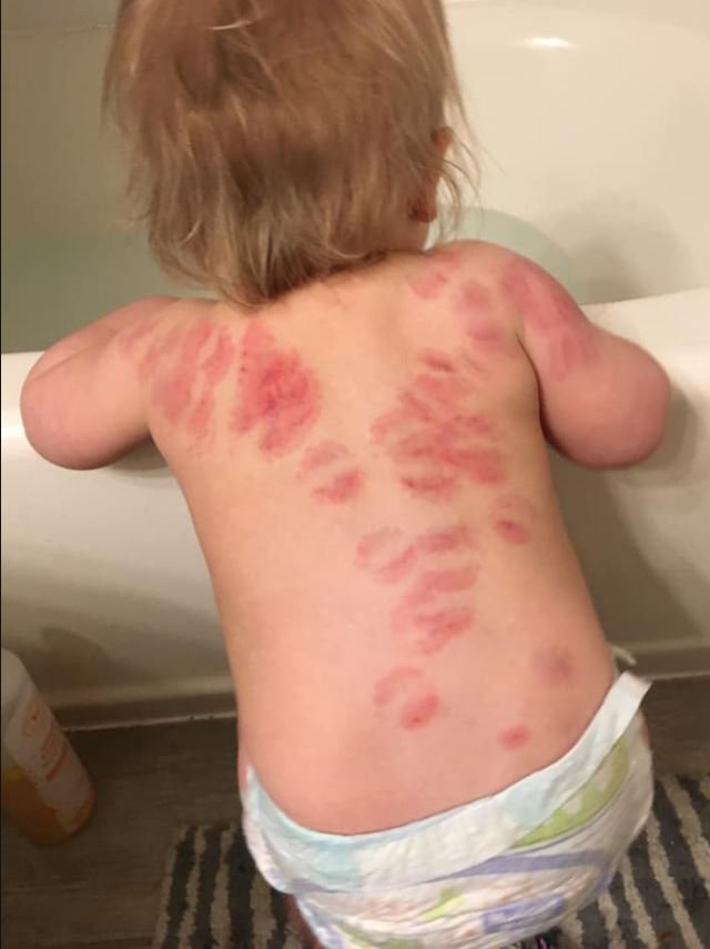 Fotografija: 15-mesečna punčka je bila vsa pogrižena, domnevno od žuželk. FOTO: Facebook