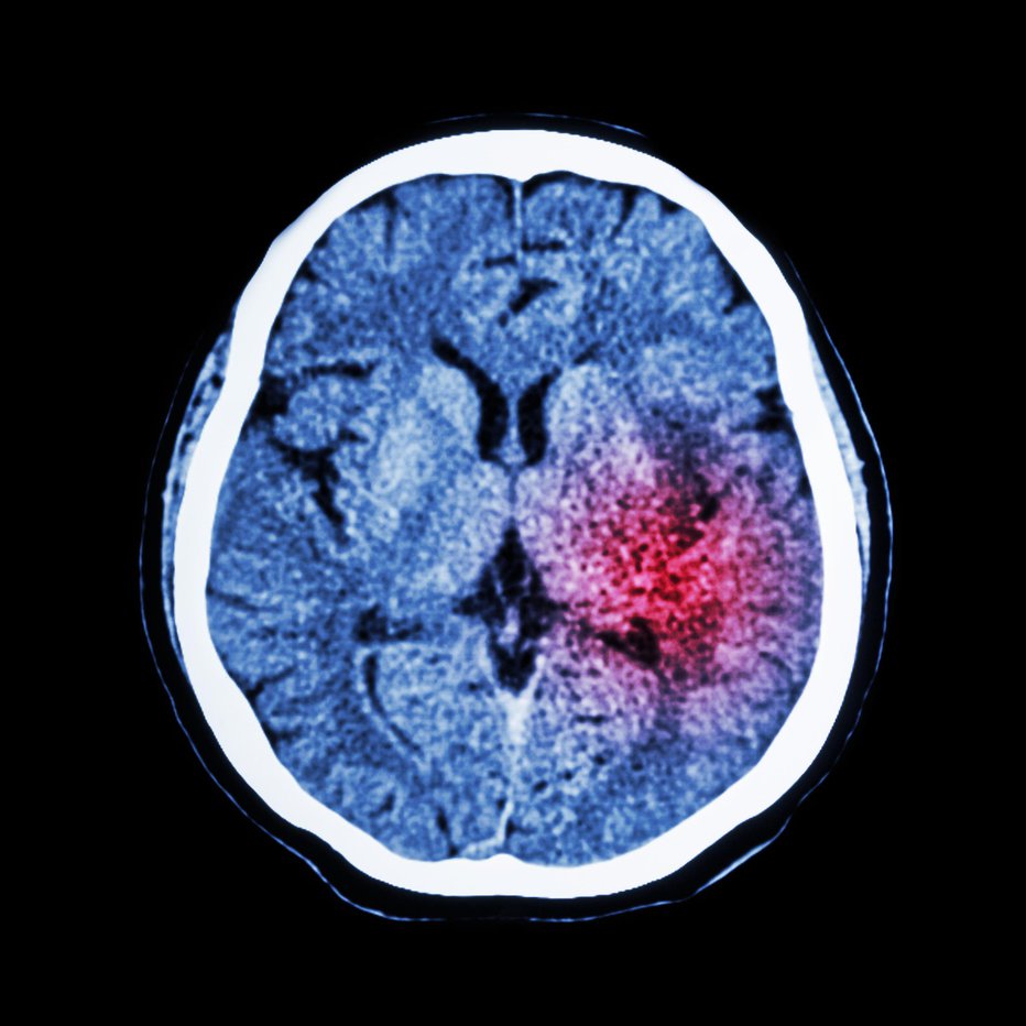 Fotografija: Možganska kap je po vsem svetu najpogostejša nevrološka bolezen, smrtnost je visoka, prav tako invalidnost. FOTOGRAFIJE: Guliver/Getty Images