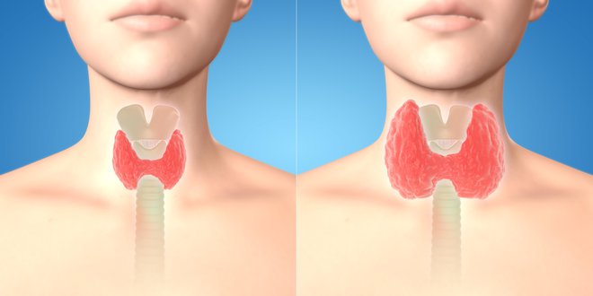 Povečana ščitnica (desno) je ena od najpogostejših ščitničnih bolezni. FOTOGRAFIJE: Guliver/Getty Images