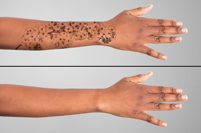 Laserji so nepogrešljivi pri odstranjevanju tetovaž in pigmentacij. FOTO: Guliver/Getty Images