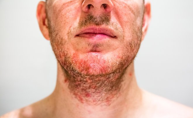 Na pojav folikulitisa lahko vpliva tudi neprevidno britje.