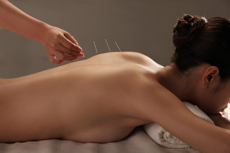 Fotografija: Akupunktura pomaga vzpostaviti pretok čija po meridianih v telesu. FOTO: Guliver/Getty Images