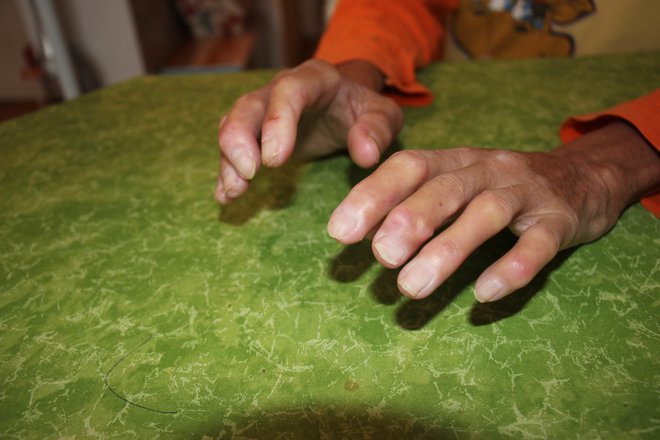 Zaradi sistemske skleroze ima prste že povsem negibne in boleče FOTOGRAFIJE: Tanja Jakše Gazvoda