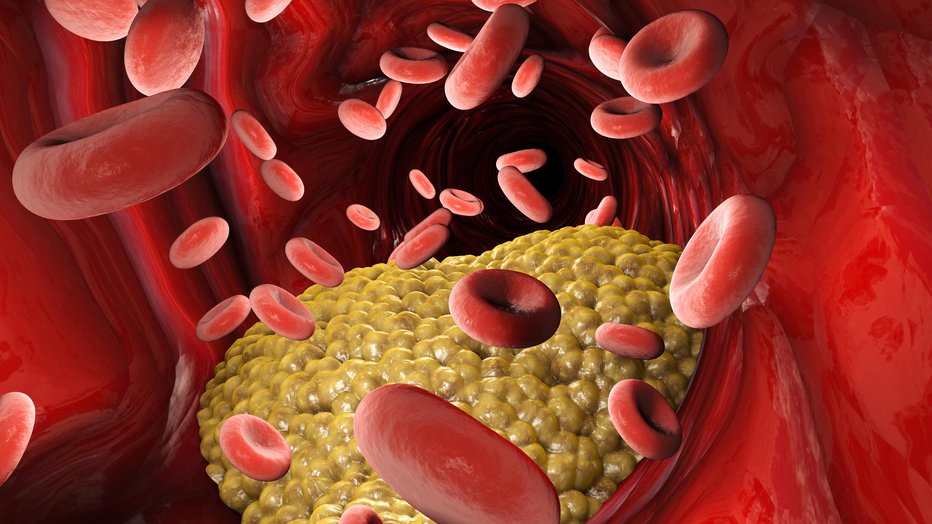 Fotografija: Preveč holesterola v krvi lahko povzroči nastanek oblog na žilnih stenah in s tem pospeši aterosklerozo. FOTO: Guliver/Getty Images