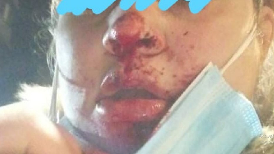 Fotografija: Zlomljeni nos ženske po napadu v Novi Gorici. FOTO: Regional Obala
