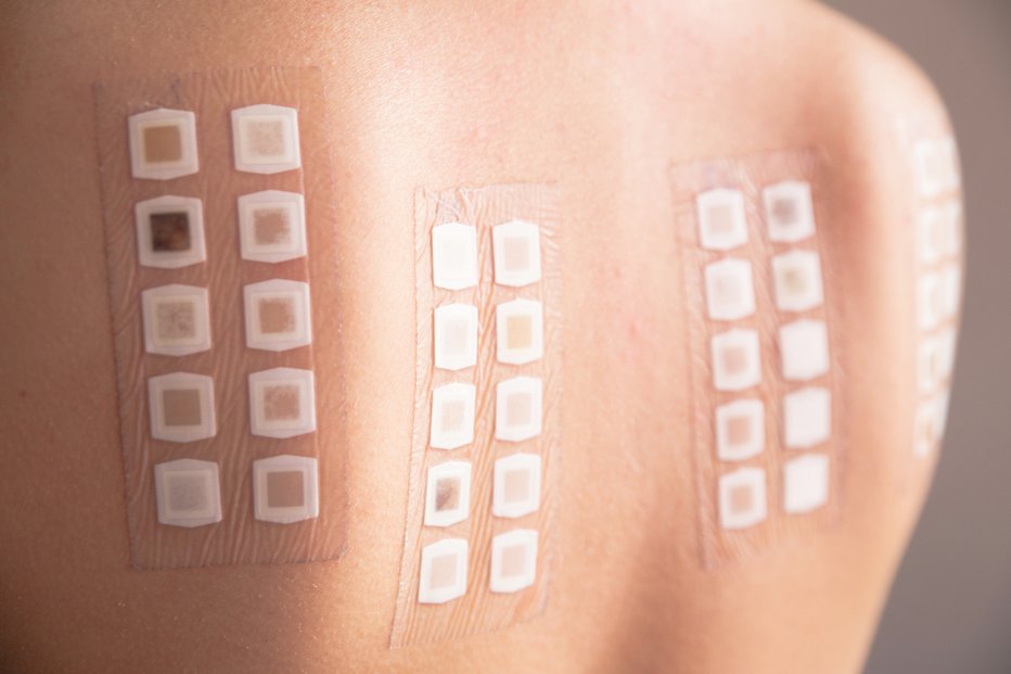 Fotografija: Tako so videti epikutani alergološki testi. Alergeni ostanejo na hrbtu dva dni, šele nato odčitajo rezultate – prvič takoj po odstranitvi in nato še enkrat ob naslednjem obisku. FOTO: Neeila, Shutterstock