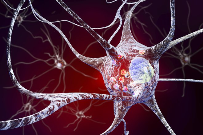 Glavna značilnost je propadanje dopaminskih nevronov. FOTO: Dr_microbe/Getty Images