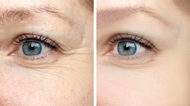 UV-sevanje pospešuje staranje kože. FOTO: Iuliia Mikhalitskaia/Getty Images