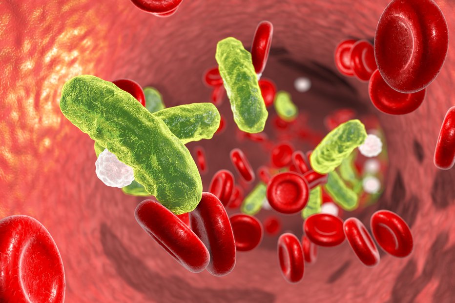 Fotografija: Zanjo je značilen sistemski vnetni odziv organizma z dokazano okužbo, t. j. prisotnost bakterij v krvi. FOTO: Dr_microbe/Getty Images