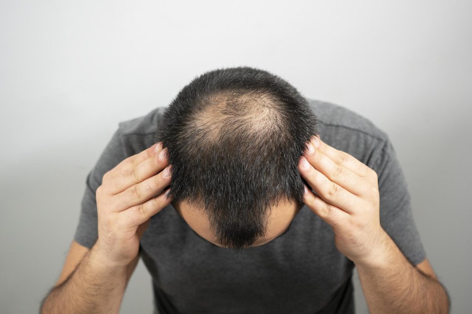 Fotografija: Najpogostejša vrsta izpadanja je postopno redčenje las na vrhu glave. FOTO: Ozanuysal/Getty Images
