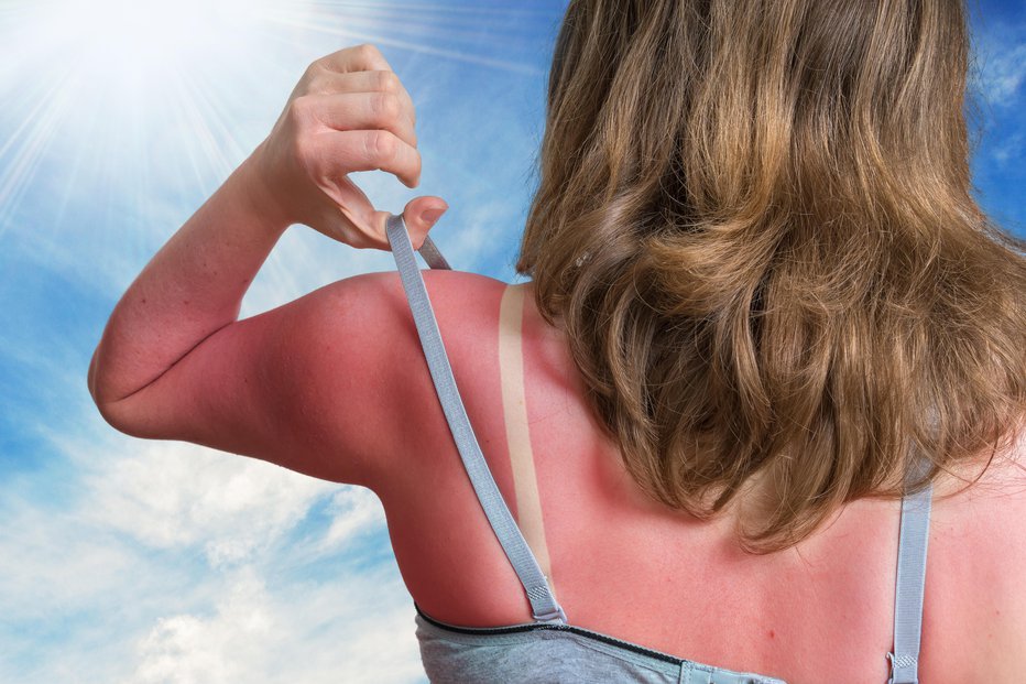 Fotografija: Ne izpostavljajte se soncu, preprečite opekline. FOTO: Vchal/Getty Images
