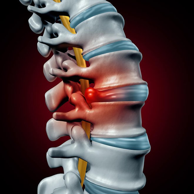 Artroza hrbtenice. FOTO: Medicofit
