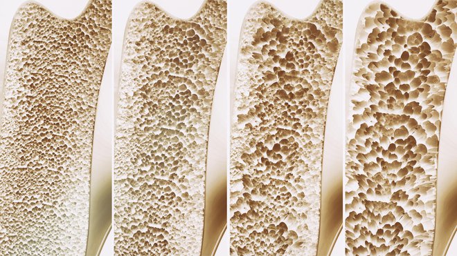 Osteoporoza je sistemska skeletna bolezen, pri kateri postanejo kosti luknjičaste, bolj krhke in se lažje zlomijo. FOTO: Crevis2/Getty Images
