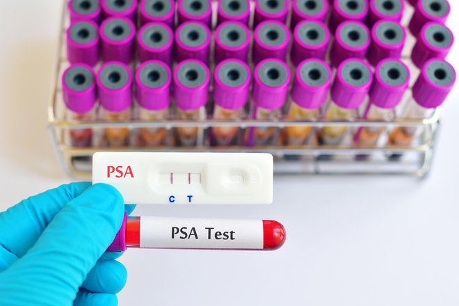 Število primerov se iz leta v leto povečuje tudi zaradi strogega upoštevanja izvida testa PSA. FOTO: Jarun011, Getty Images
