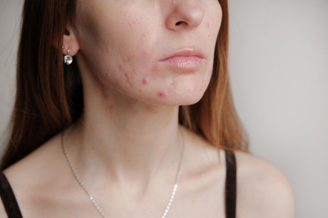 Dermatolog predpiše ustrezno terapijo, ki jo prilagodi posamezniku. FOTO: Jevelin, Getty Images
