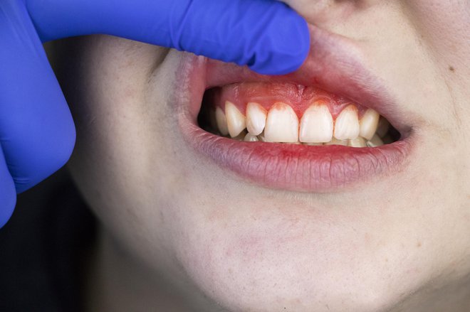 Najpogostejša bolezen dlesni je gingivitis. FOTO: Alona Siniehina/Getty Images
