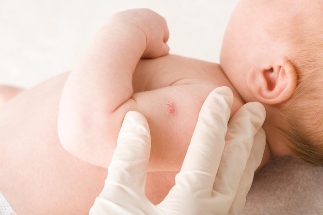 Cepljenje novorojenčkov je v Sloveniji od 2005. obvezno le v določenih primerih. FOTO: Getty Images/iStockphoto