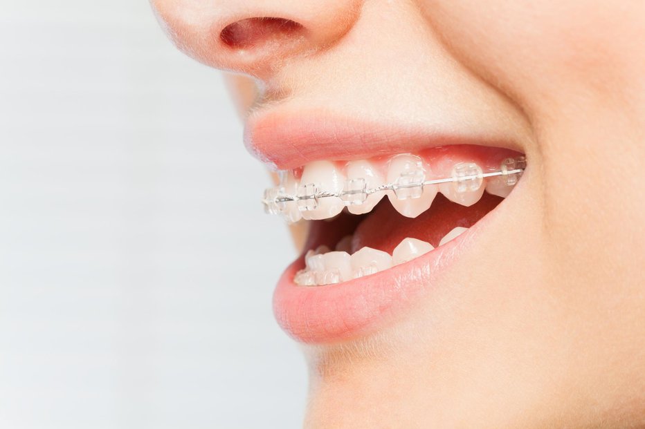 Fotografija: Ravni zobje postajajo neuslišana želja vse več otrok. FOTO: Serrnovik Getty Images/istockphoto