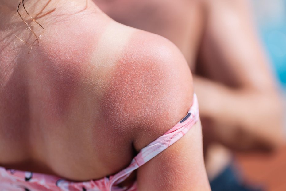 Fotografija: Večina primerov malignega melanoma je povezana z občasnim intenzivnim izpostavljanjem soncu, zlasti v otroštvu. FOTO: Iuliia Burmistrova/Getty Images