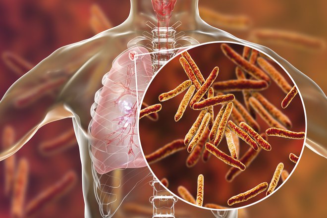 Tuberkuloza najpogosteje prizadene pljuča, lahko tudi druge organe.