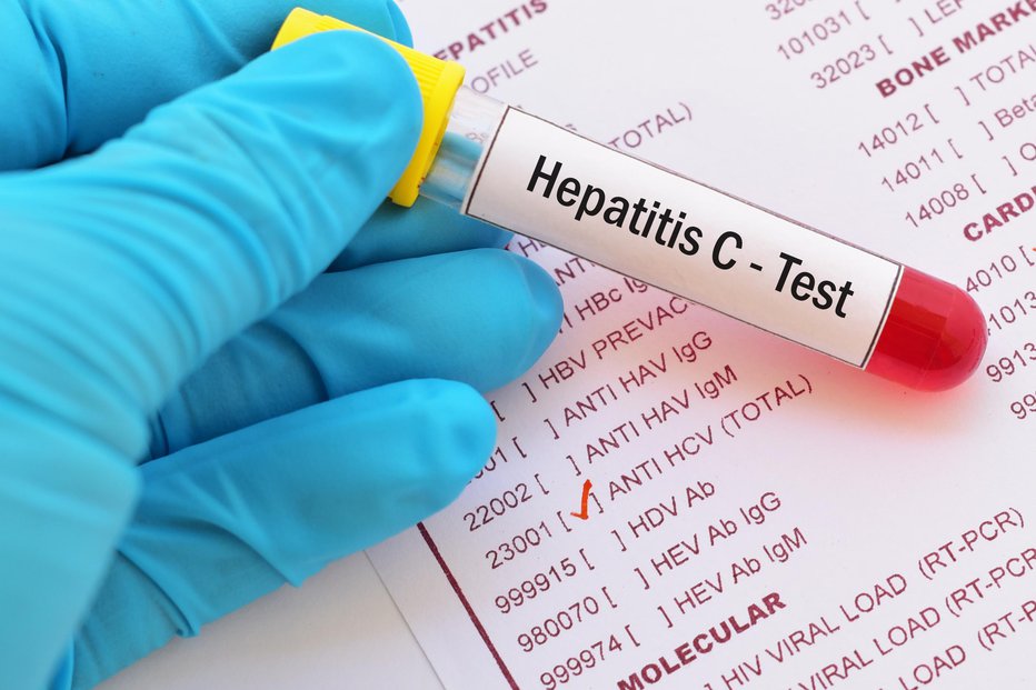Fotografija: Hepatitis C lahko dolga leta poteka brez bolezenskih znakov in tako posameznik sploh ne ve, da je okužen. FOTO: Jarun011 Getty Images/istockphoto