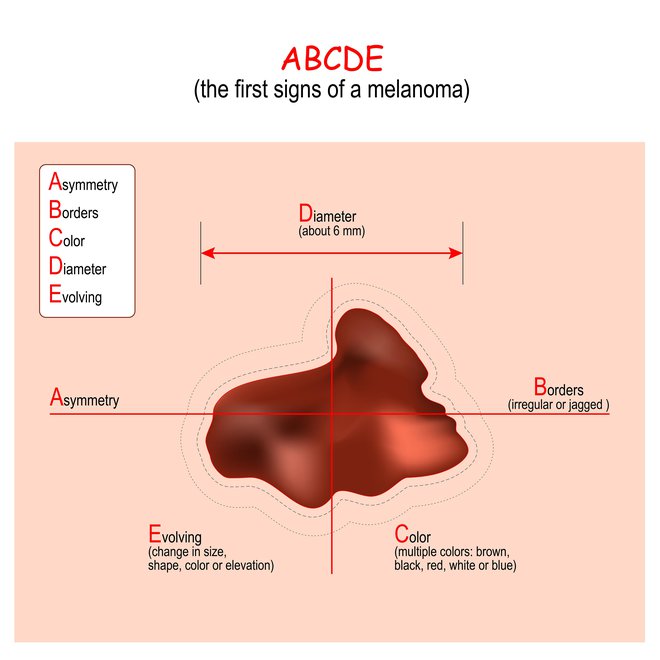 Dobra preventiva zgodnjega odkrivanja melanoma je sistem ABCDE – asimetrija, nejasni robovi znamenj, več odtenkov rjave, črne, rdeče, bele ali modre barve, premer (več kot 5 mm). Pa tudi F – melanomske lezije. FOTO: Ttsz/getty images